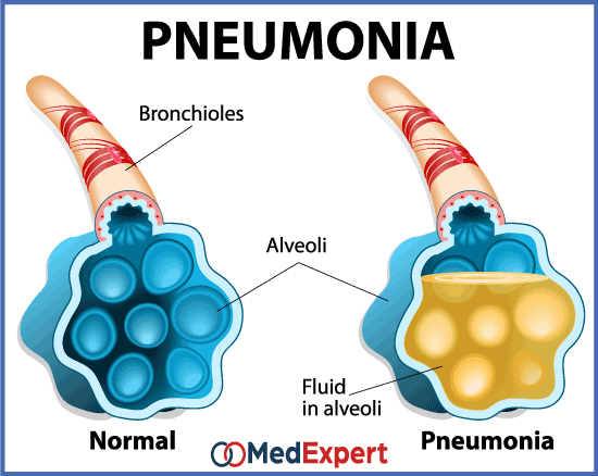 pneumonia; Pneumonia symptoms; Pneumonia treatment