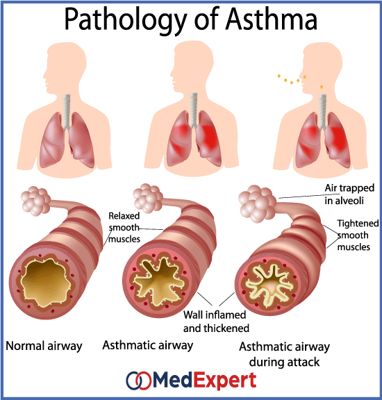 Allergic asthma treatment, symptoms and diagnosis | MED Expert