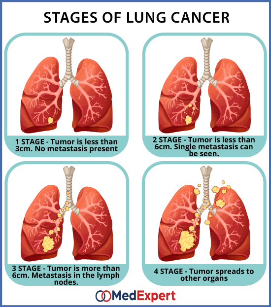 lung cancer symptoms and treatment
