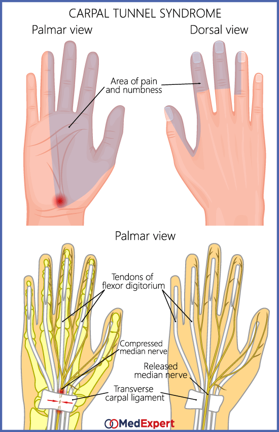 carpal tunnel syndrome treatment surgery