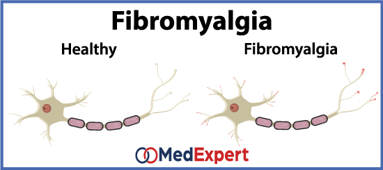 fibromyalgia treatment and test