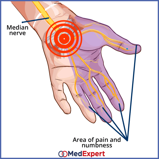 carpal tunnel syndrome treatment and symptoms