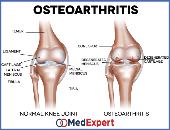 Osteoarthritis treatment and diagnosis