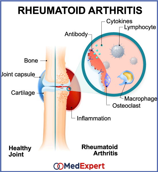 rheumatoid arthritis symptoms and treatment