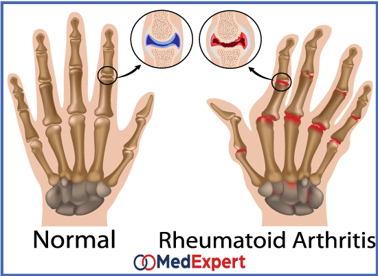rheumatoid arthritis symptoms and causes