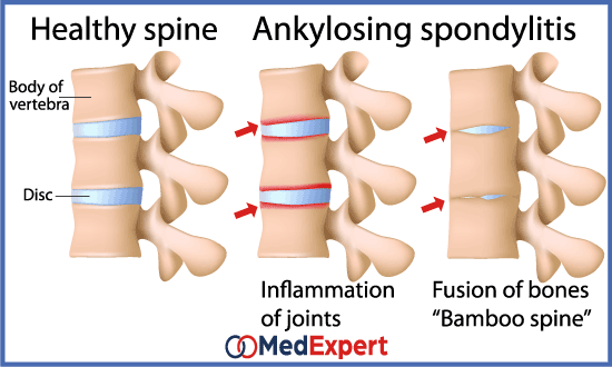 rheumatoid spondylitis symptoms and treatment