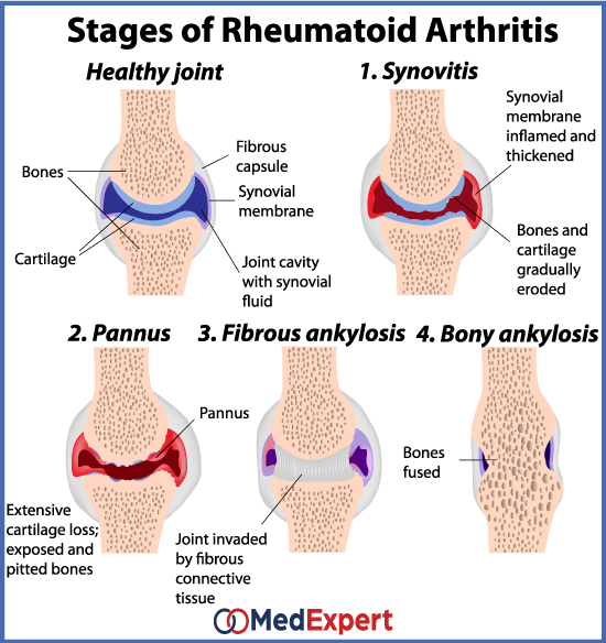 a gerinc rheumatoid arthritise)