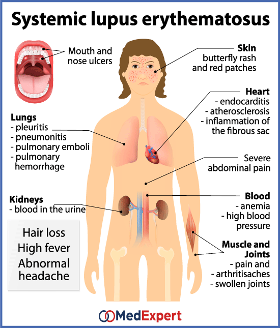 Symptoms And Treatment Of Systemic Lupus Erythematosus