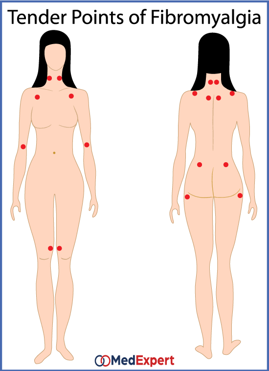 fibromyalgia symptoms and causes