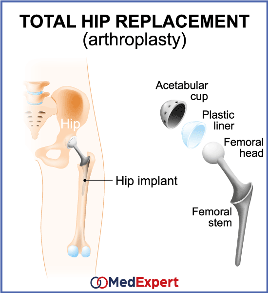 Osteoarthritis treatment options, arthroplasty