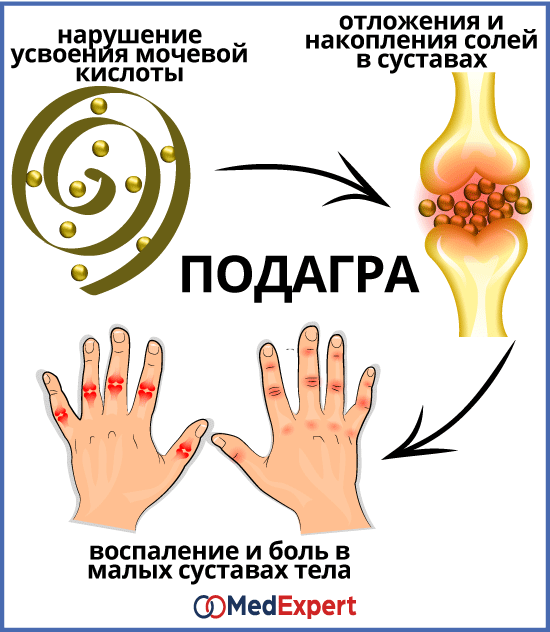 подагра диагностика и лекарства