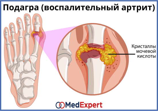 лечение и диагностика подагры