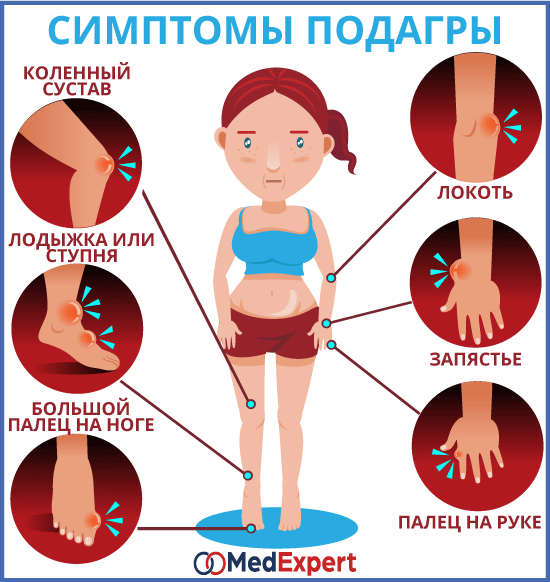 симптомы и признаки подагры