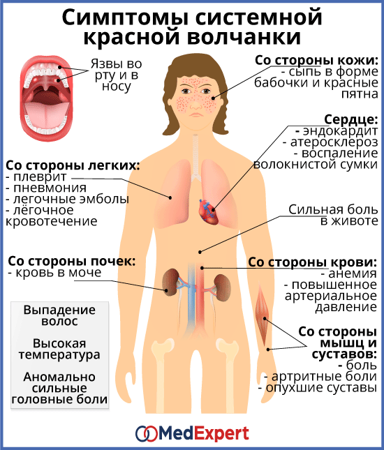 системная красная волчанка симптомы и лечение