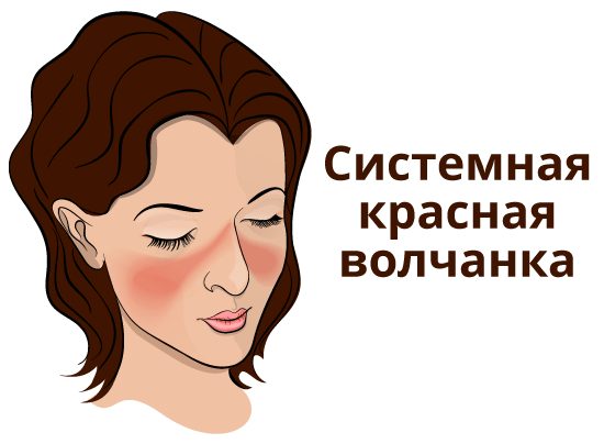 системная красная волчанка прогноз и лечение