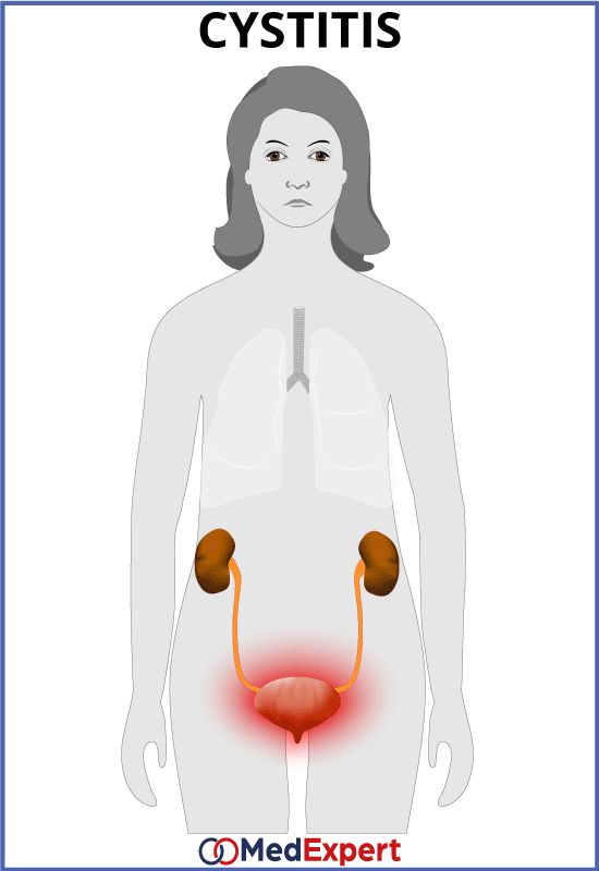 urinary tract infection; UTI symptoms; Urinary tract infection treatment