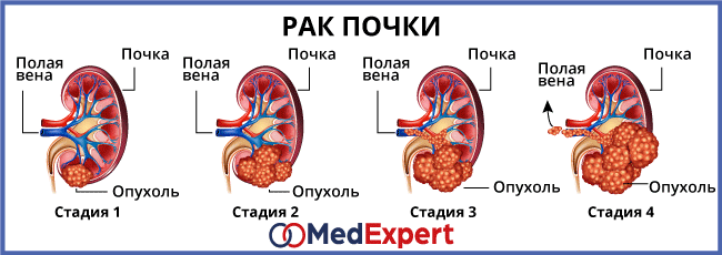 Диета После Рака Почки