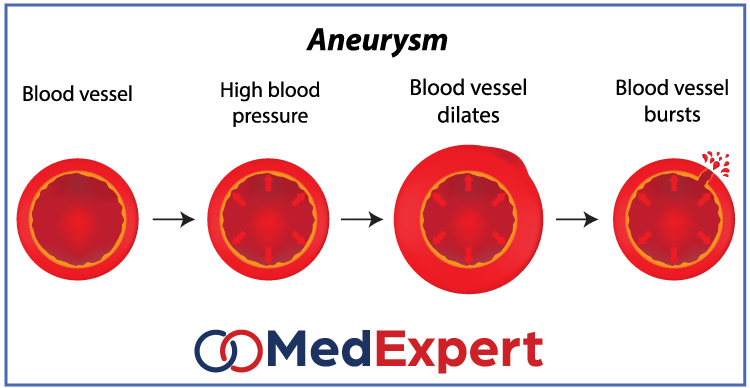 aortic aneurysm; Aortic aneurysm symptoms; Aortic aneurysm treatment