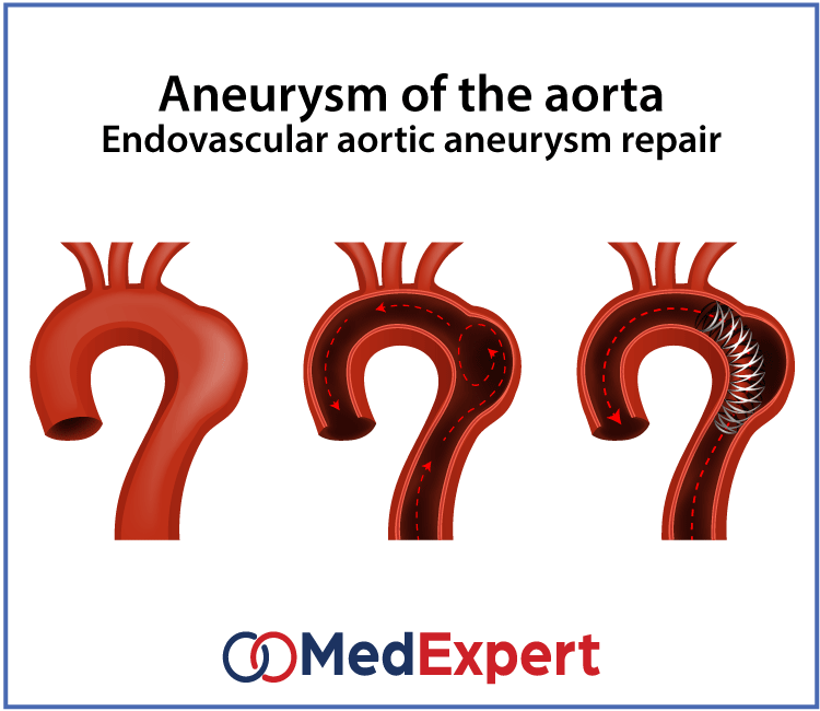 endovascular aneurysm repair