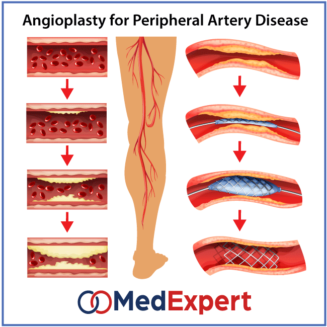 peripheral artery disease treatment with angioplasty and stenting