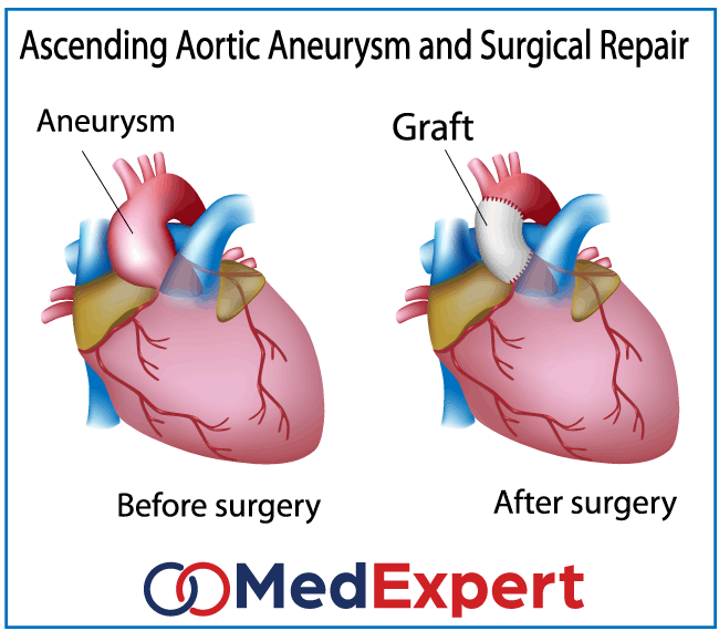 aortic aneurysm surgical repair