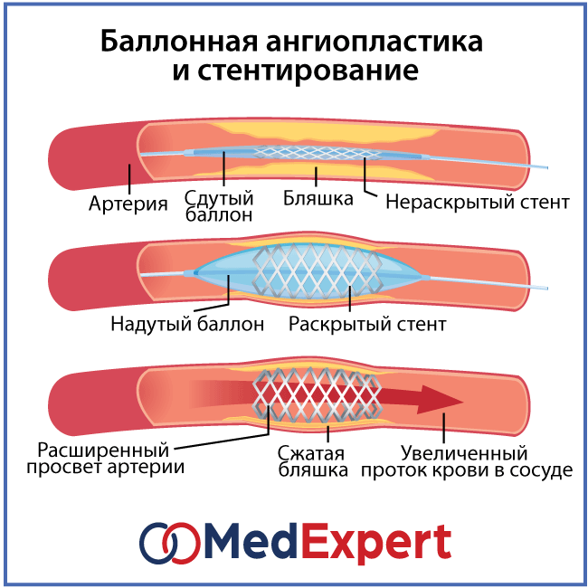 Диета После Установки Стентов