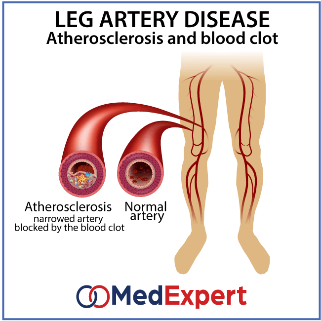 peripheral artery disease; PAD symptoms; Peripheral artery disease treatment