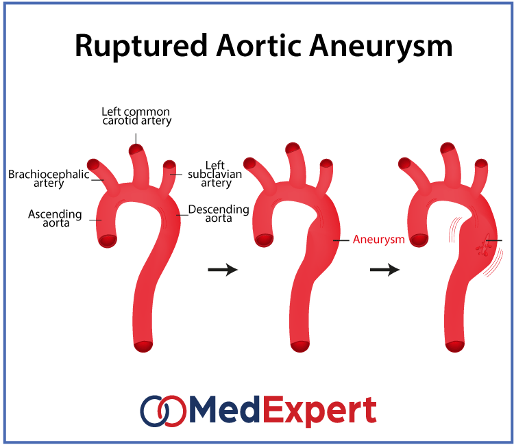 aortic aneurysm rupture