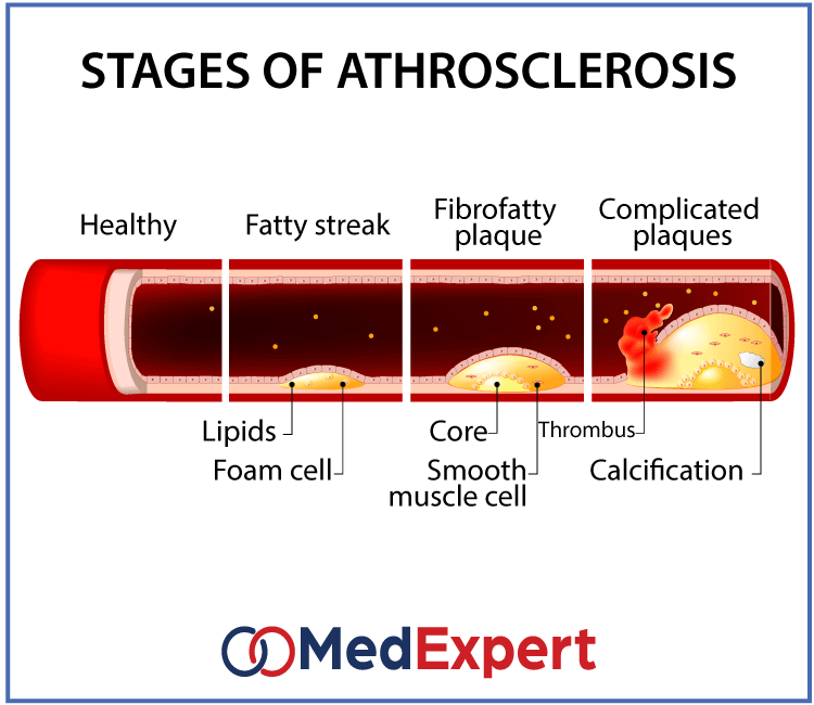 stages of athrosclerosis
