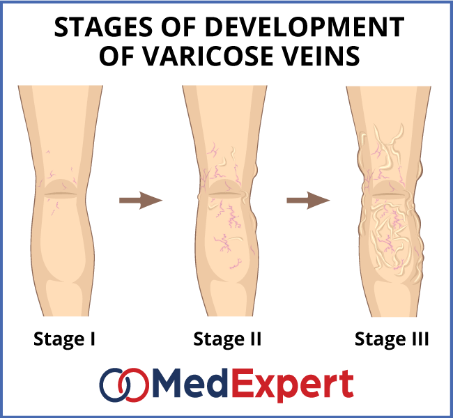 varicose veins different stages