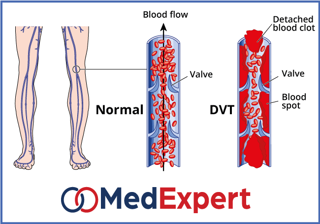 deep vein thrombosis; DVT symptoms; Deep vein thrombosis treatment; DVT causes