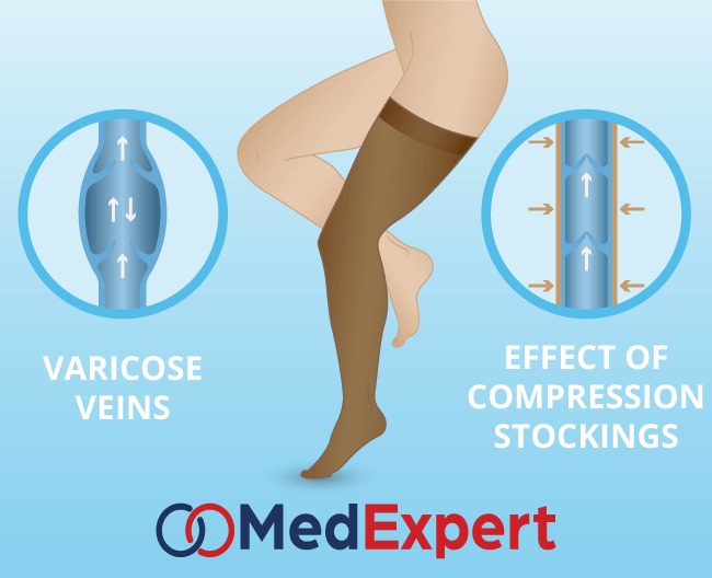 deep vein thrombosis compression stockings
