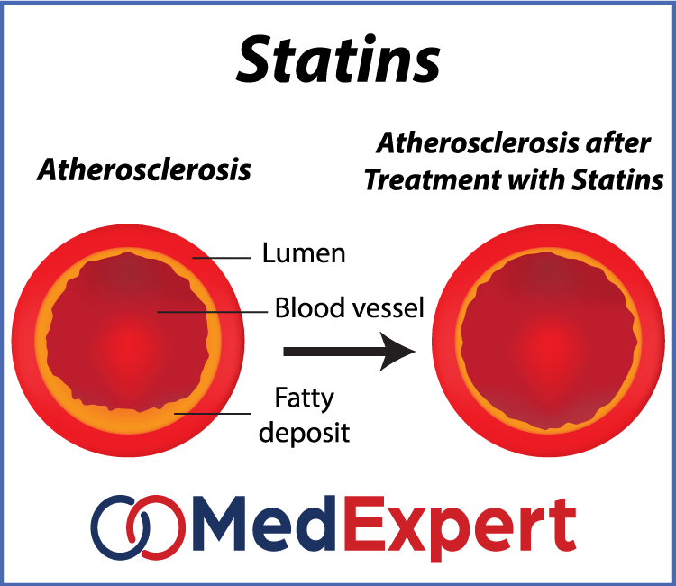 carotid artery disease; Carotid artery disease symptoms; carotid artery disease treatment
