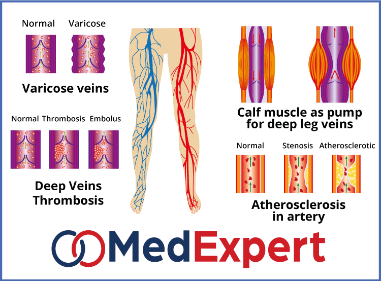 chronic venous insufficiency; CVI symptoms; Chronic venous insufficiency treatment