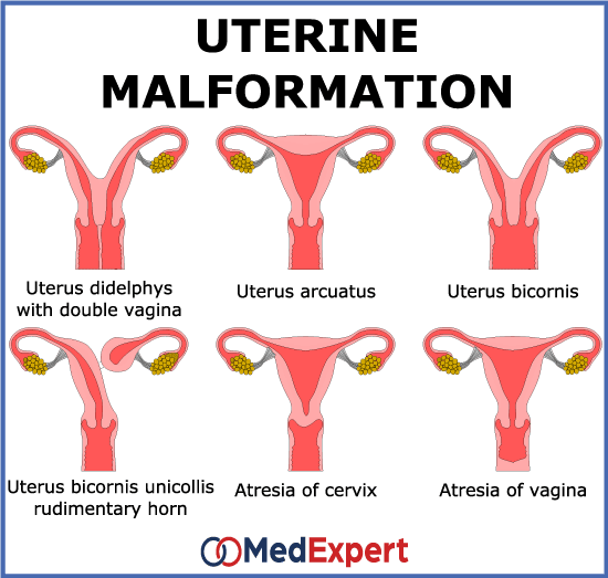 Abnormal uterus anatomy treatment and pregnancy | MED Expert