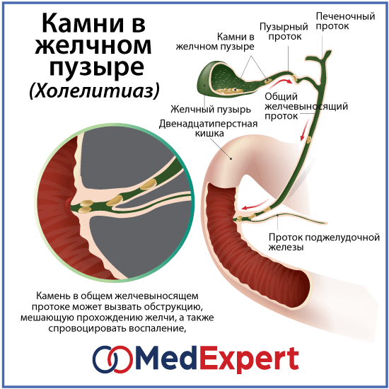 Удаления камня в протоке. Конкремент общего желчного протока. Конкремент пузырного протока. Камни в желчевыводящих протоках. Камень в общем желчном протоке.