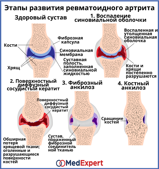 Ревматоидный артрит является примером гиперчувствительности типа Артрит артроз суставов симптомы и лечение: найдено 90 изображений