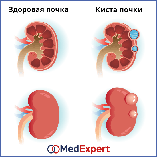 Киста почки у новорожденного